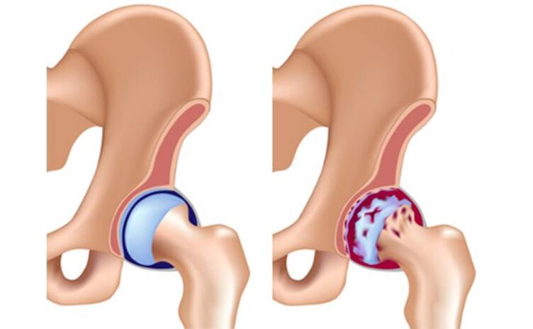Articulation de la hanche saine affectée par l'arthrose