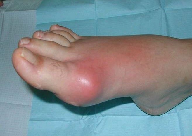 Tableau clinique du gonflement et de l’inflammation de l’arthrite du pied
