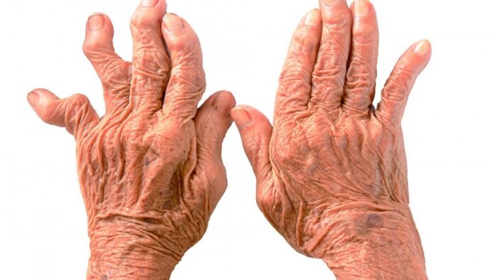 la polyarthrite rhumatoïde comme cause de douleurs articulaires des doigts