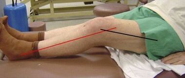 Arthrose progressive de l'articulation du genou