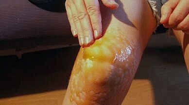 Frottement pour le traitement de l'arthrose de l'articulation du genou