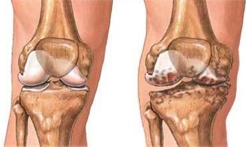 Arthrose du genou