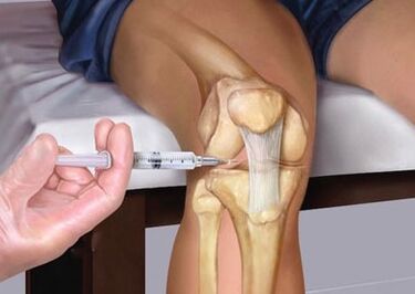 Injection dans l'articulation