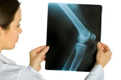 Traitement de l'arthrose de l'articulation du genou