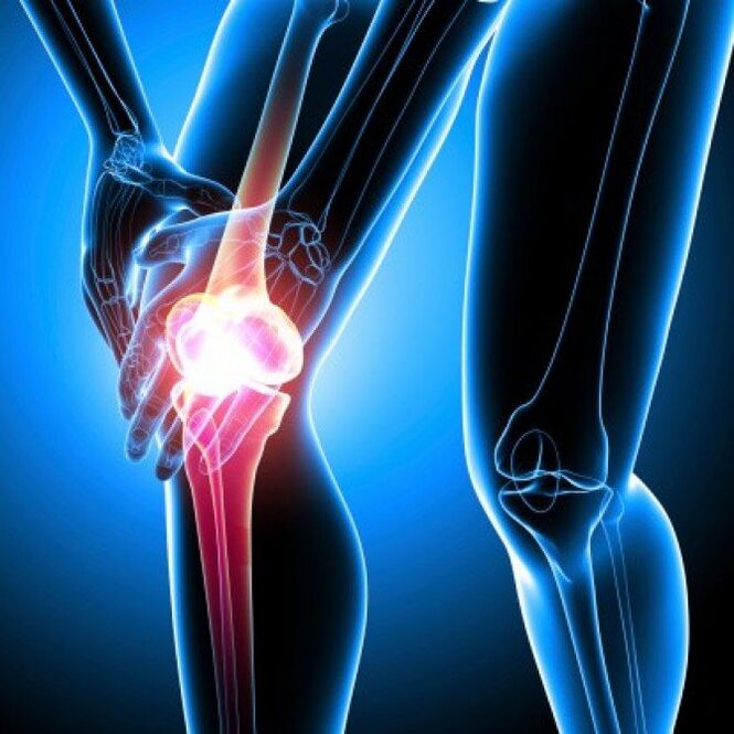 La polyarthrite rhumatoïde avancée peut causer des douleurs à la hanche